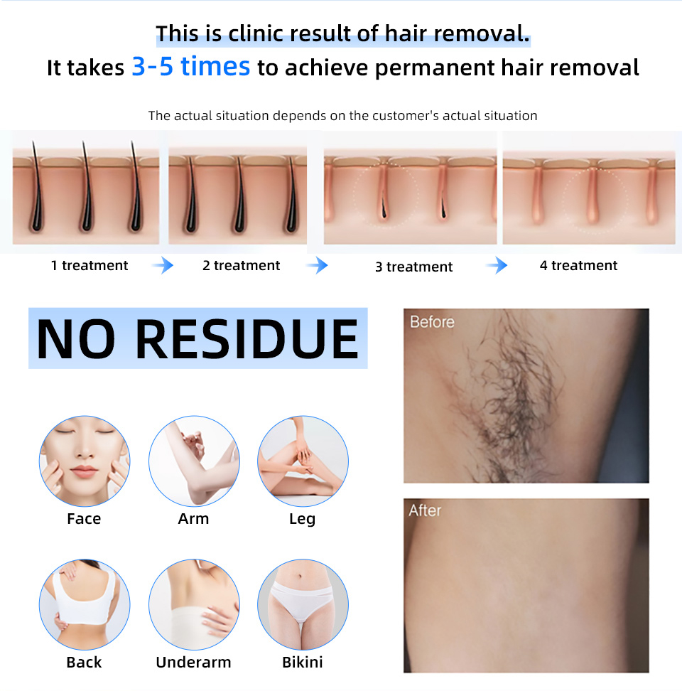 Harga Pabrik 20000000   Penghi - Industrial Laser Hair Removal Machine ulasan dan harga