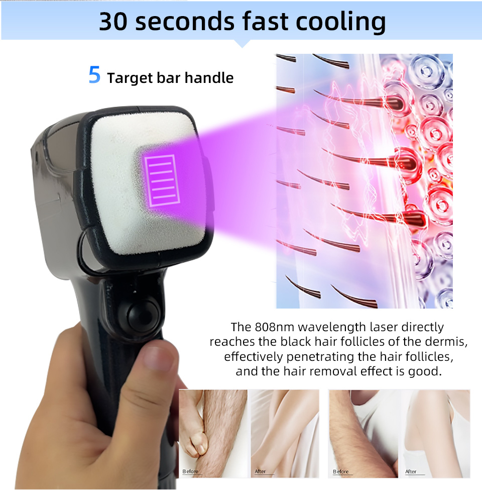 Laser Dioda Gelombang 808 NM P - Industrial Laser Hair Removal Machine ulasan dan harga